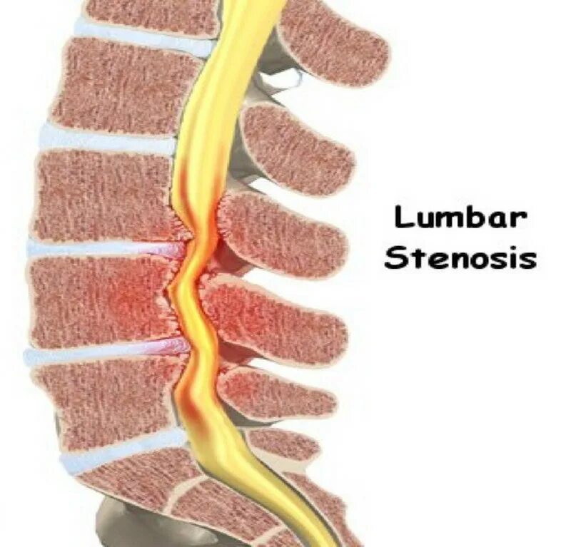 Поясничный абсолютный стеноз. Стеноз спинномозгового канала. Дегенеративный спинальный стеноз l3-l4. Поясничный спинальный стеноз. Фораминальный стеноз позвоночного канала.