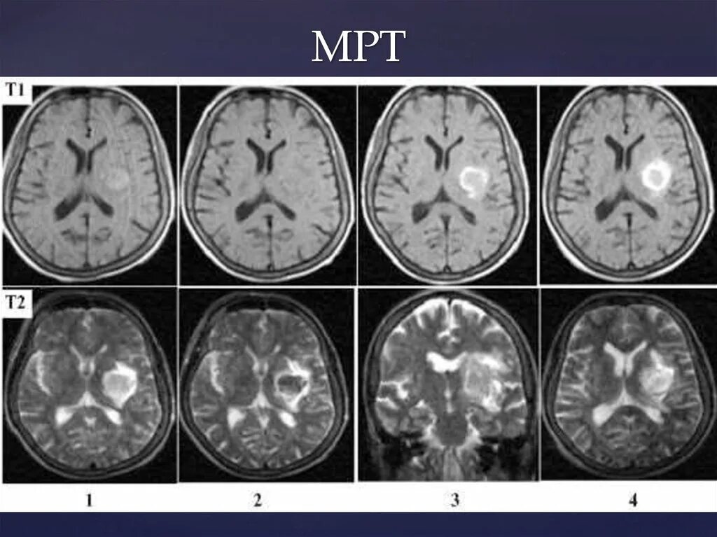 Мрт ишемический инсульт т1. ОНМК геморрагический инсульт. ОНМК по ишемическому типу кт. Стадии ишемического инсульта на кт.