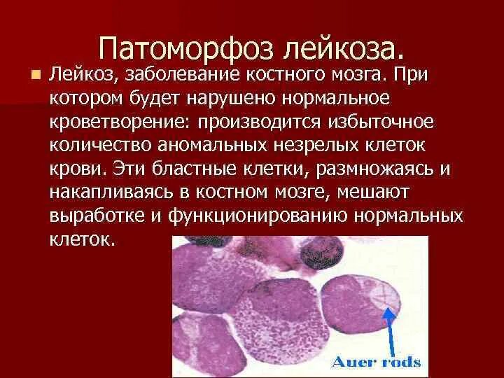 Вред костный мозг. Острый лейкоз костного мозга симптомы. Бластные клетки в костном мозге. Хронический миелобластный лейкоз костный мозг гистология. Острый лейкоз костный мозг.