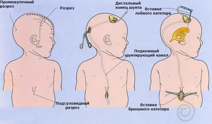 Как выглядит шунт. Гидроцефалия головного шунт. Шунтирование гидроцефалии головного мозга ребенка. Шунтирование гидроцефалии головного мозга у новорожденного. Шунт при гидроцефалии у новорожденных.