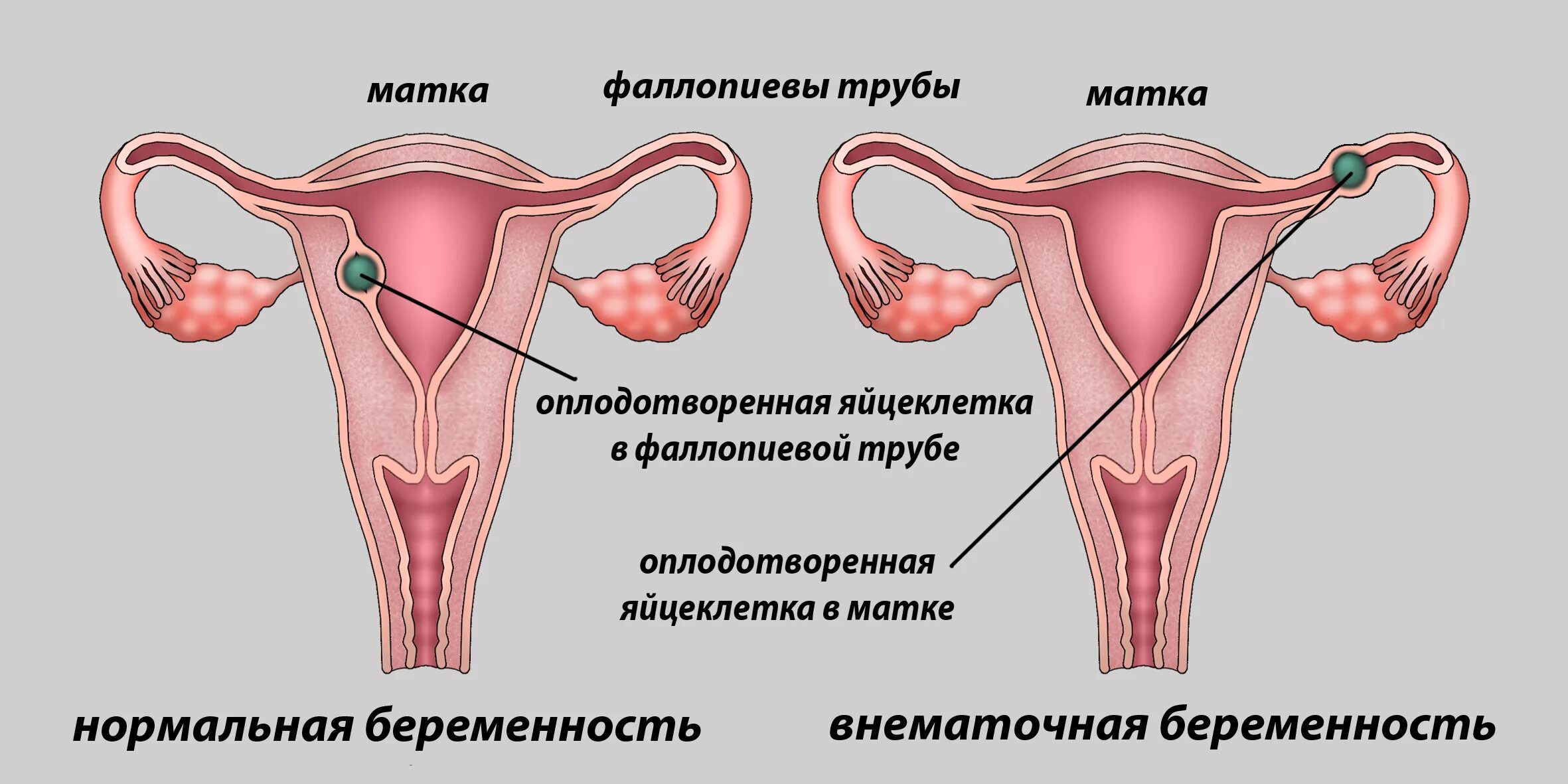 Почему происходит внематочная. Маточная и внематочная беременность. Матка и трубы внематочная беременность. Внематочнаябеременость. Внематочная беременнос.