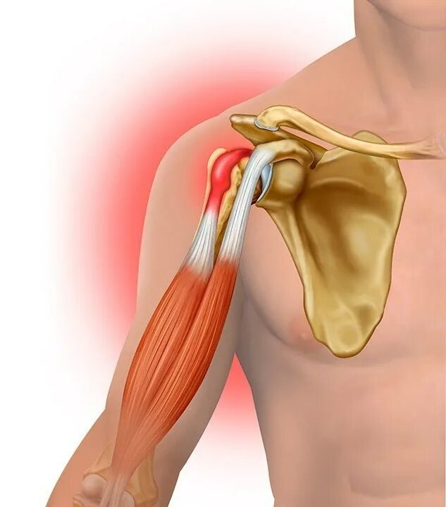 Повреждение сухожилия подлопаточной мышцы. Тендинит сухожилия бицепса плечевого сустава. Тендинит сухожилия двуглавой мышцы плеча. Тендинит — воспаление сухожилий плечевого сустава;. Тендинит сухожилия бицепса.