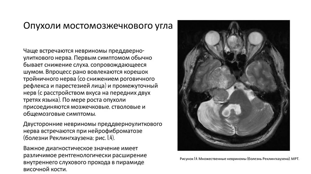 Невринома слухового нерва мрт описание. Опухоли мосто-мозжечкового угла клиника. Липома мосто-мозжечкового угла кт. Объемное образование мосто мозжечкового угла клиника. Мозжечковая опухоль