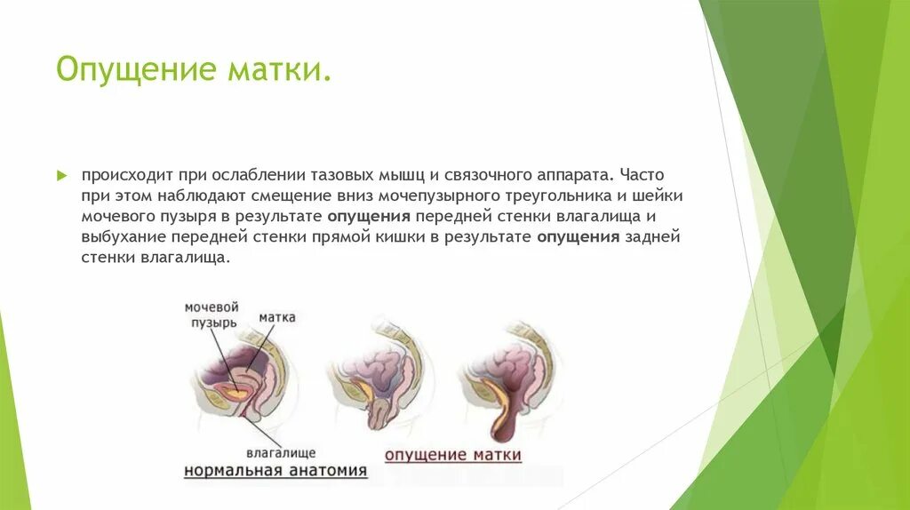 гимнастика для шейки матки при опущении. чем грозит опущение. признаки опущения матки симптомы. опущение и выпадение внутренних половых органов. как понять что матка опущена.