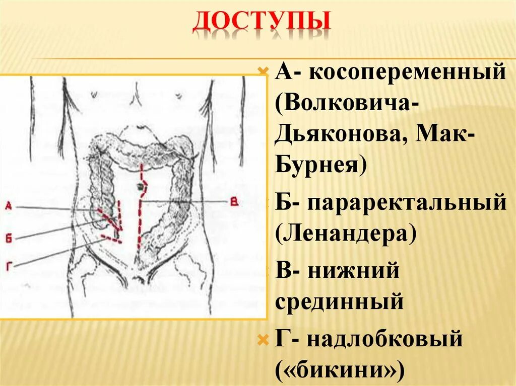 Точки аппендицита. Разрез Мак Бурнея Волковича Дьяконова. Аппендэктомия разрез Волковича-Дьяконова. Аппендэктомия по Волковичу Дьяконову. Разрез по Волковичу-Дьяконову схема.