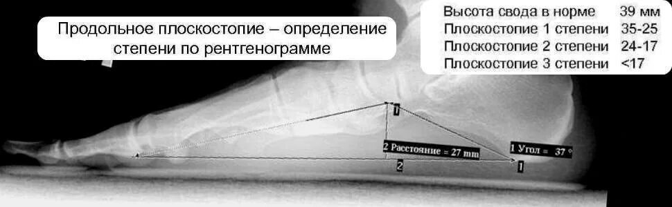 Продольное плоскостопие 2. Продольное плоскостопие 2 степени угол свода стопы. плоскостопие 3 степени высота свода. продольное плоскостопие для военкомата. высота свода стопы норма.