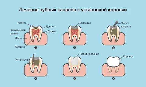 Самая распространенная ошибка при препарировании... 