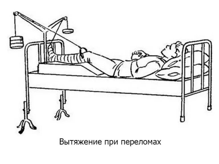 Перелом шейки бедра скелетное вытяжение. Шина Беллера для скелетного вытяжения. Вытяжение костных отломков. Метод постоянного вытяжения при переломе.