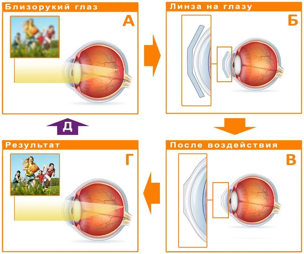 Линзы для глаз коррекция зрения. Принцип работы ночных линз для коррекции зрения. Принцип работы ночных линз. Ортокератологические линзы. Линзы для коррекции миопии.