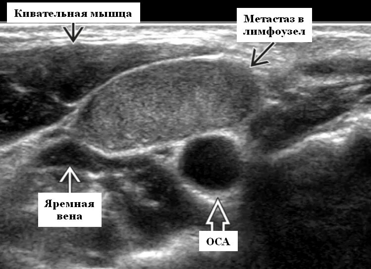 Щитовидная железа узи лимфоузлы. Медуллярная опухоль щитовидной железы УЗИ. Карцинома щитовидной железы УЗИ. Лимфатический узел щитовидной железы УЗИ. Лимфома щитовидной железы на УЗИ.