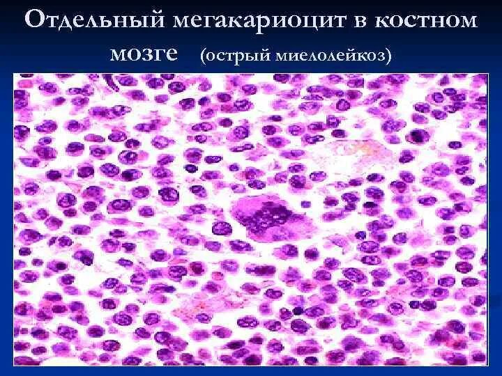 Мегакариоциты красного мозга. Мегакариоциты красного мозга. Мегакариоцит гистология. Мегакариоцит гистология функция. Мегакариоциты в костном мозге.