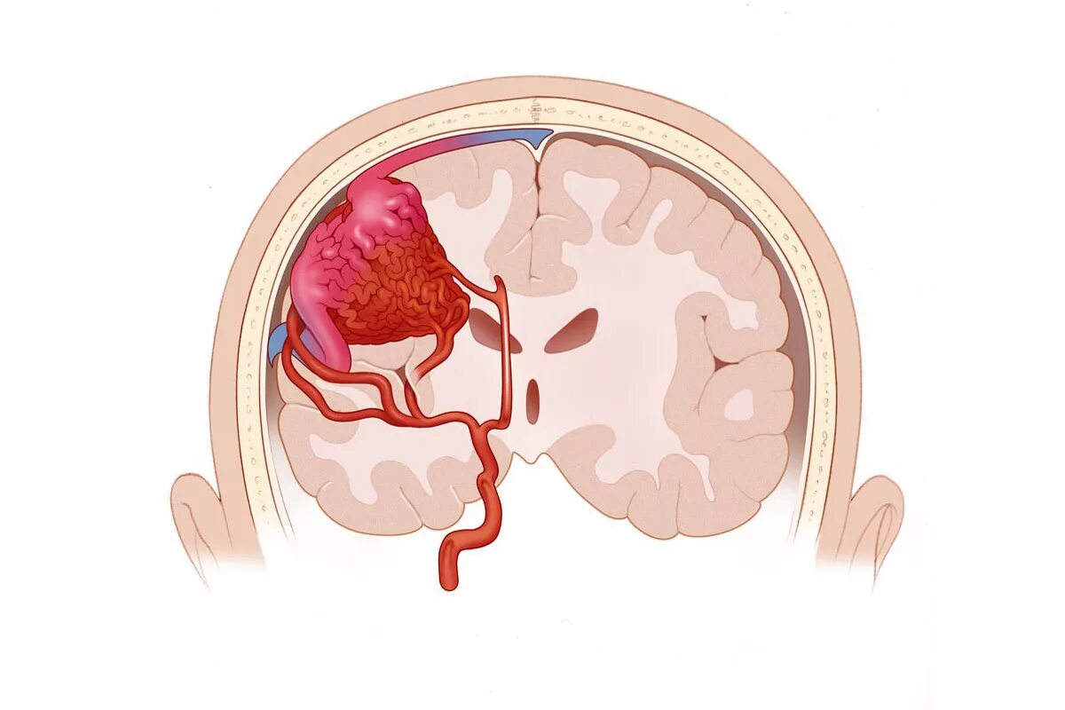 Артериовенозная мальформация головного. Мальформации сосудов головного мозга. Субарахноидальное кровоизлияние аневризма.