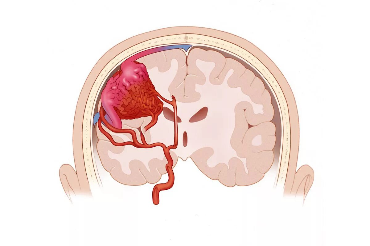 Аневризма перегородки у ребенка. Артериовенозная мальформация головного. Мальформации сосудов головного мозга. Субарахноидальное кровоизлияние аневризма. Артериовенозная мальформация сосудов.