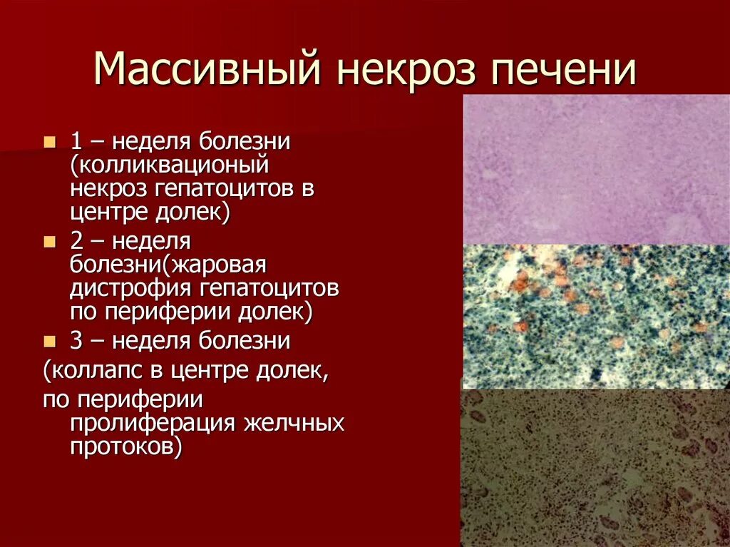 Лечение после некроза. Массивный прогрессирующий некроз печени макро. Массивный прогрессирующий некроз печени патанатомия. Острый массивный некроз печени. Острый токсический некроз печени.