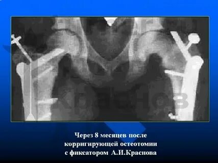Эпифизеолиз код мкб