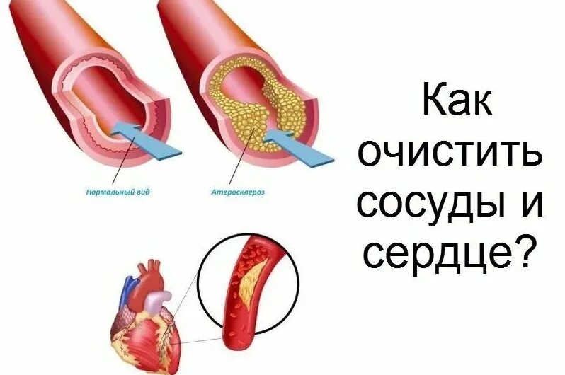 Прочистка сосудов. Как чистят сосуды сердца. Атеросклероз чистка сосудов.