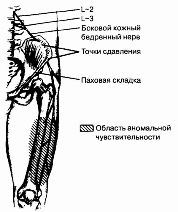 Нейропатия подкожного бедренного нерва. Невропатия бедренного нерва анатомия. Нейропатия пахово бедренного нерва. Латеральный бедренный кожный нерв.