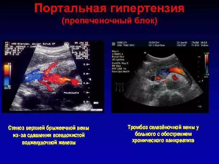 Тромбоз брюшной. Ультразвуковая допплерография воротной вены. Синдром портальной гипертензии УЗИ. Допплерография при портальной гипертензии. Ультразвуковая допплерография при портальной гипертензии.