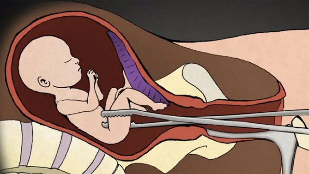 После выскабливания забеременела. Вакуумная аспирация плода. Хирургический аборт плод. Рисунки искусственного прерывания беременности.