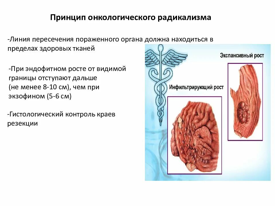 Онкология презентация. Онкологические принципы. Принципы онкологического радикализма. Эндофитный рост опухоли