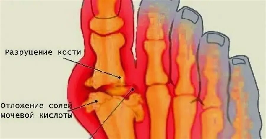 Подагра болезнь аристократов. Почему болезнь королей