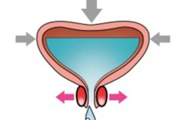 Подтекания после мочеиспускания у мужчин