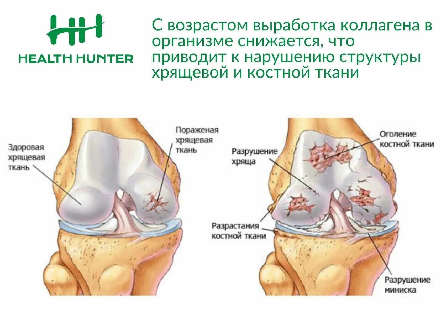 Поразить разрушить. Разрушение хряща коленного сустава. Разрушение хрящевой ткани коленного сустава. Деформирующий артроз коленного сустава схема. Хрящ коленного сустава артроз.