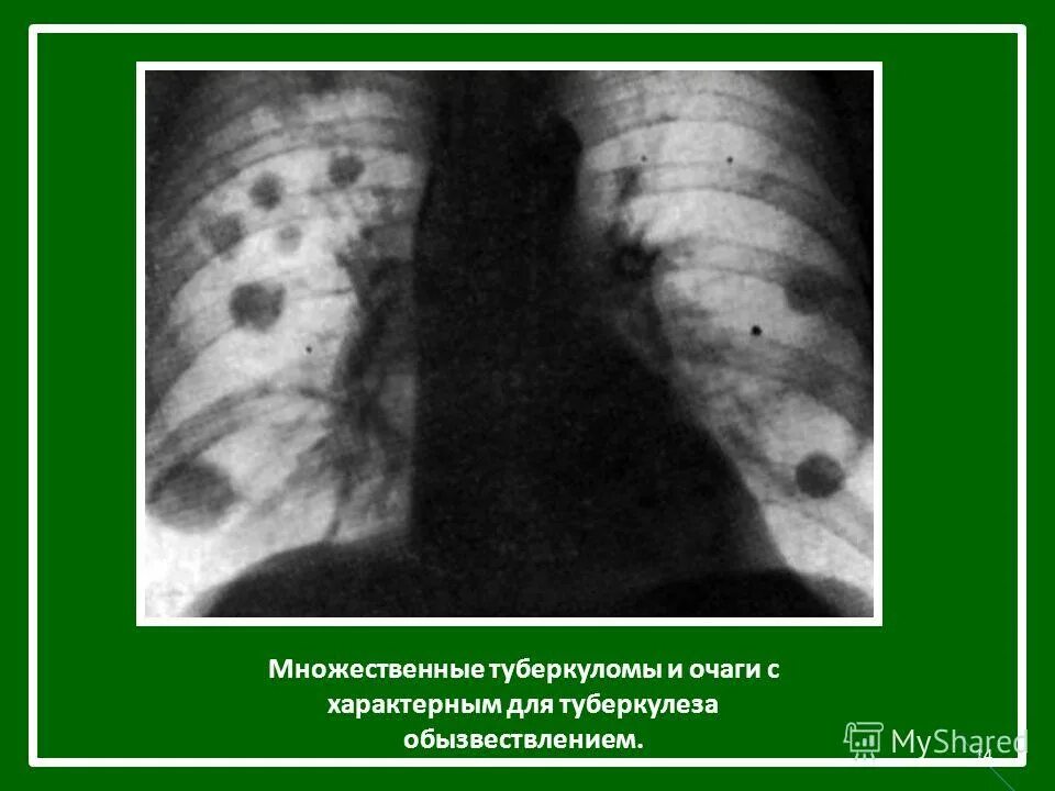 Почему в легких