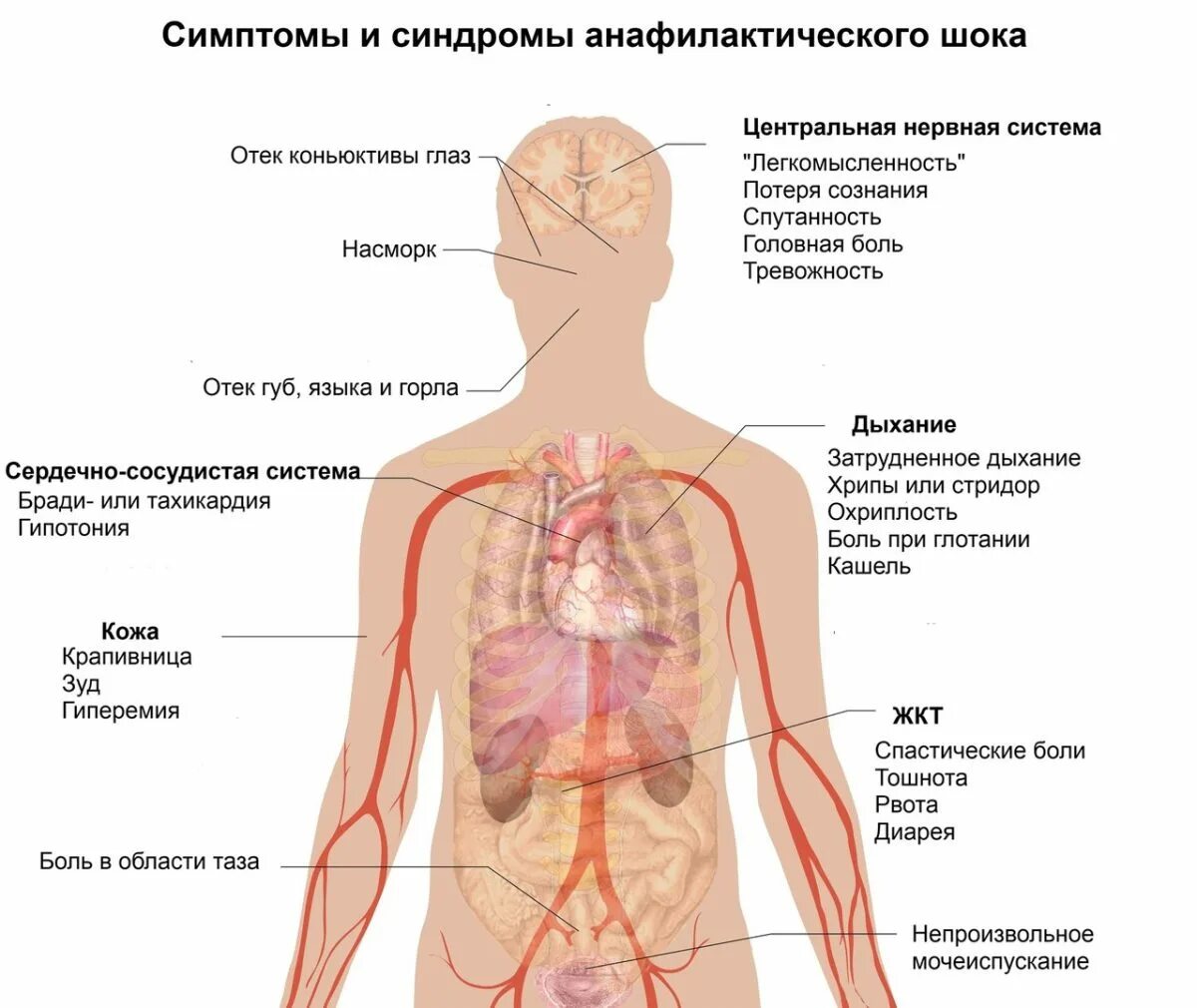 Признаки анафилактического шока. Сыпь при анафилактическом шоке. Анафилактический ШОК это аллергическая реакция. Клинические проявления анафилактического шока. Клинические проявления анафилаксии.