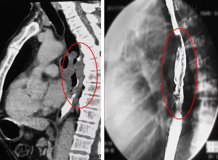 Кт пищевода и желудка. Опухоль средней трети пищевода. Кт при опухоли пищевода.