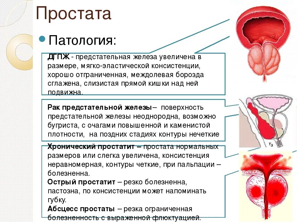 Простатит, аденома предстательной железы. Простатит, доброкачественная гиперплазия предстательной железы. Доброкачественная гиперплазия предстательной железы стадии. ДГПЖ предстательной железы что это такое. Нарушение предстательной железы