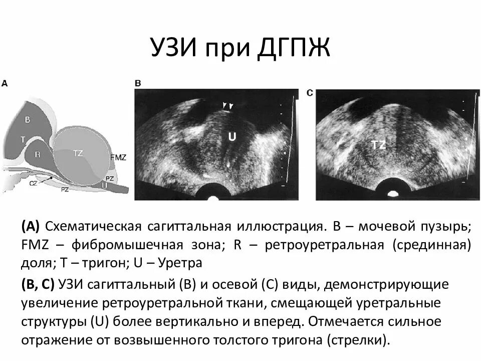 Дгпж узи. Узлы гиперплазии предстательной железы УЗИ. Степени гиперплазии предстательной железы по УЗИ.