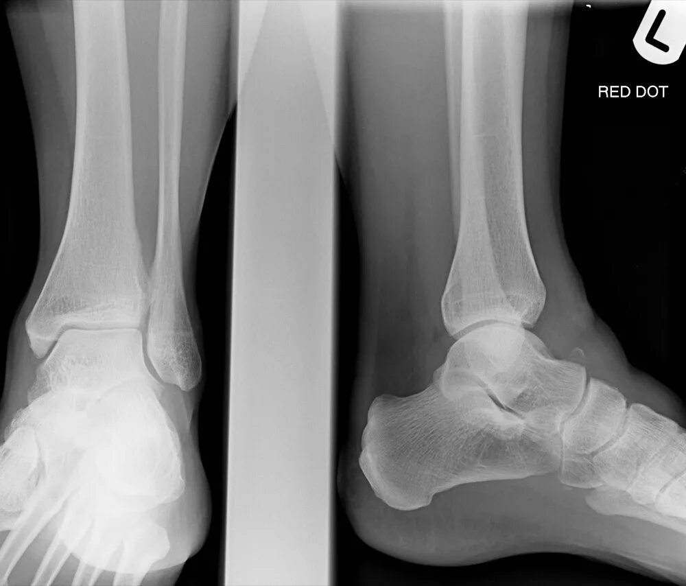 Трещина кости на ноге. Перелом таранной кости рентген. Таранная кость перелом рентген. Таранная кость стопы рентген. Таранная кость голеностопа перелом.