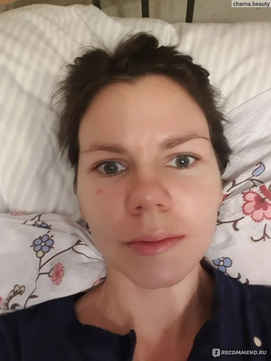 Удаление 8 отзывы. Доктор субботин рубцовск. Удаление 4х зубов мудрости под наркозом. Лицо после удаления восьмерок. Удаление 8 отзывы.