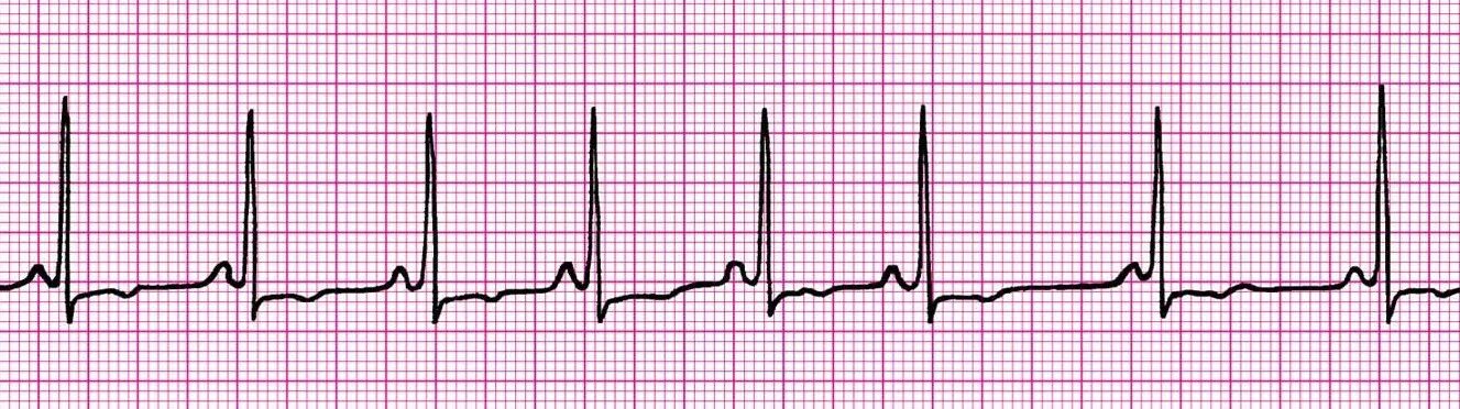 синусовая тахикардия код 10. синус тахикардия. стадии тахикардии. синусовая тахикардия код 10. синусовая тахикардия мкб-10 шифр.