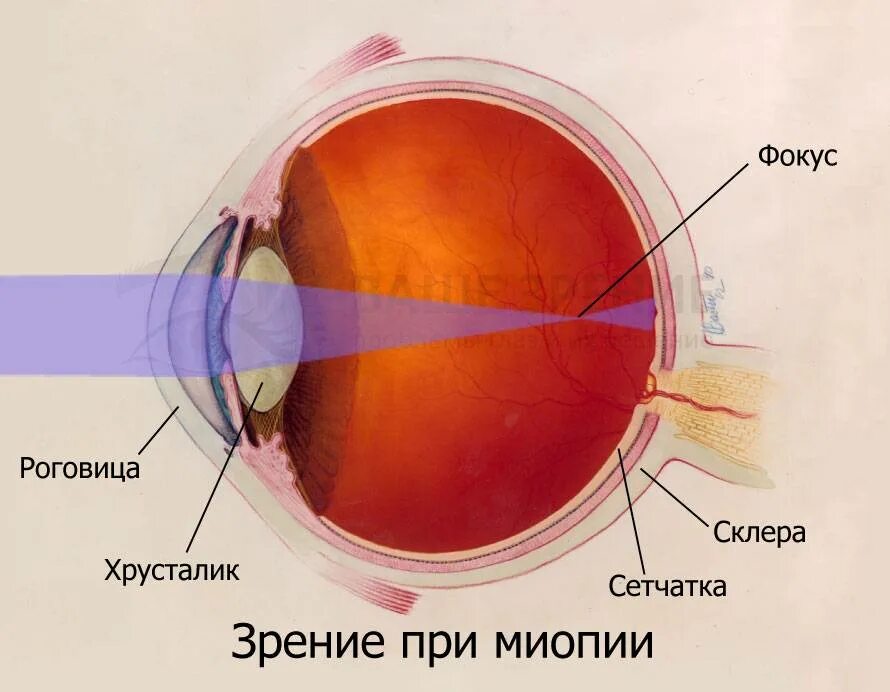 Строение глаза при миопии. Зрение при близорукости. Близорукость глазное яблоко. Миопия глаза что это такое.