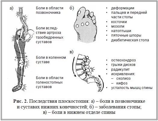 Плоскостопие травматические повреждения. Плоскостопие и позвоночник. Последствия плоскостопия. Запястье голень и позвоночник