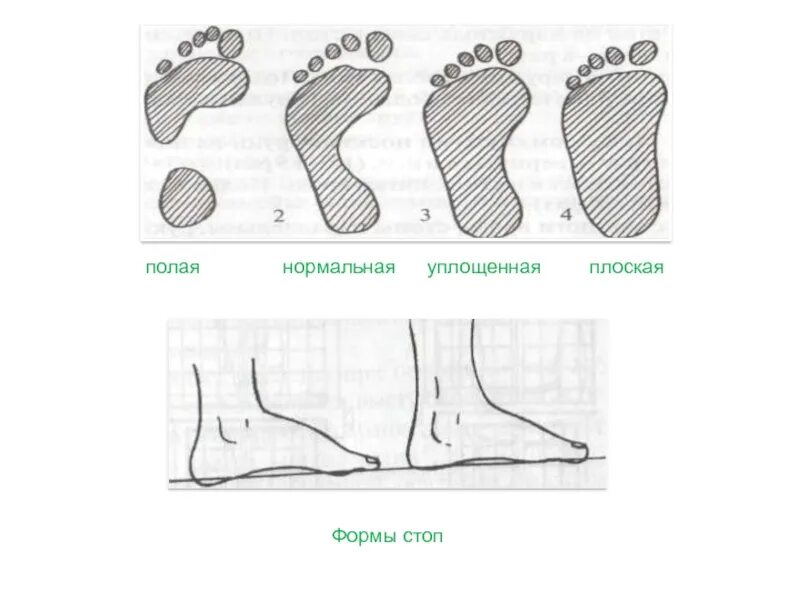 Форма стопы. Нормальная форма стопы. Форма стопы нормальная уплощенная. Стопа нормальная уплощенная плоская. 3 типа стопы