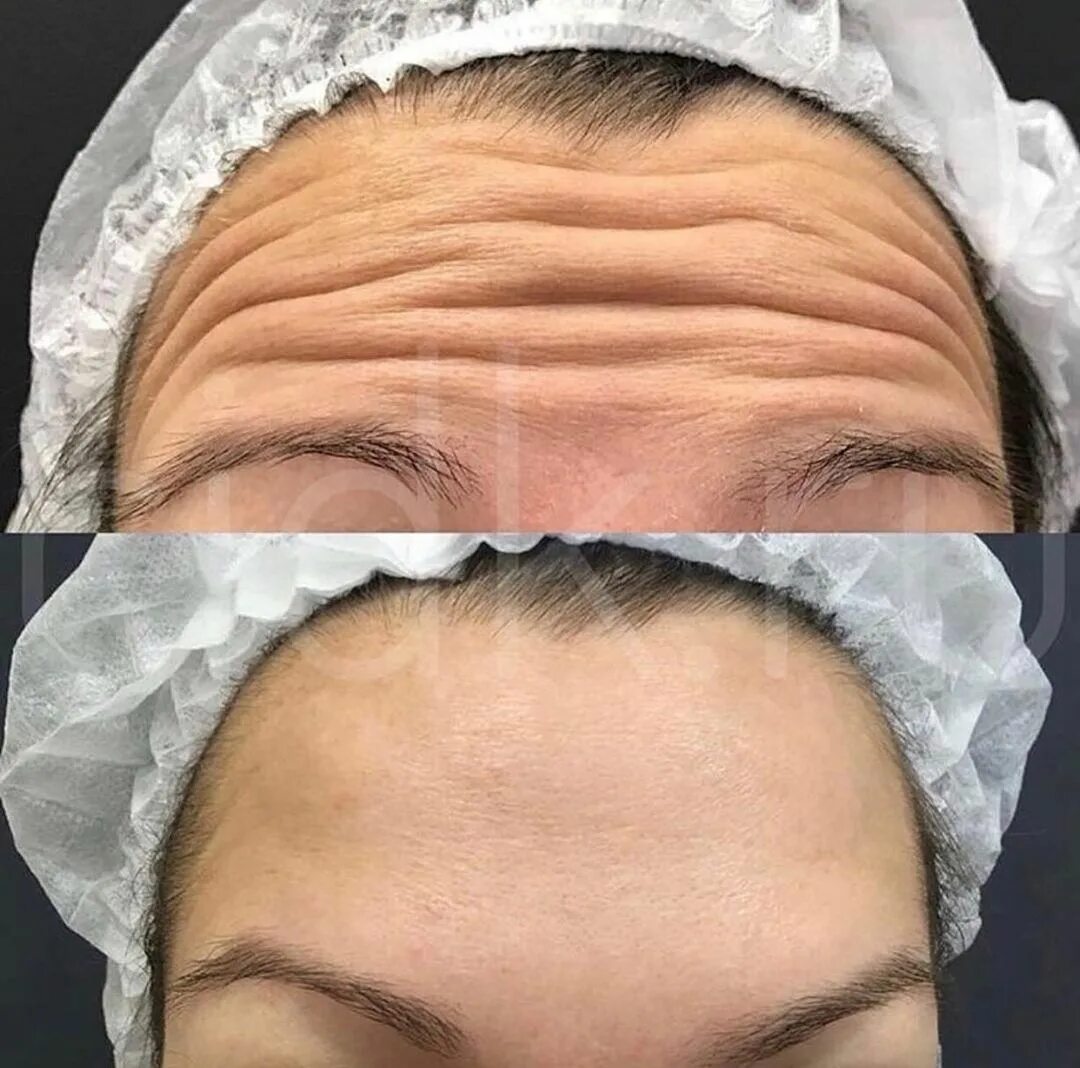 Точки введения диспорта схема. Схема уколов ботокса на лице. Лицо ботокс схема. Ботокс для лица схема уколов. Схема введения диспорта в лоб.