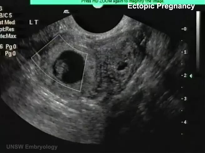 Внематочная беременность. Трубная беременность УЗИ. Внематочная беременность на УЗИ. Шеечная беременность УЗИ.