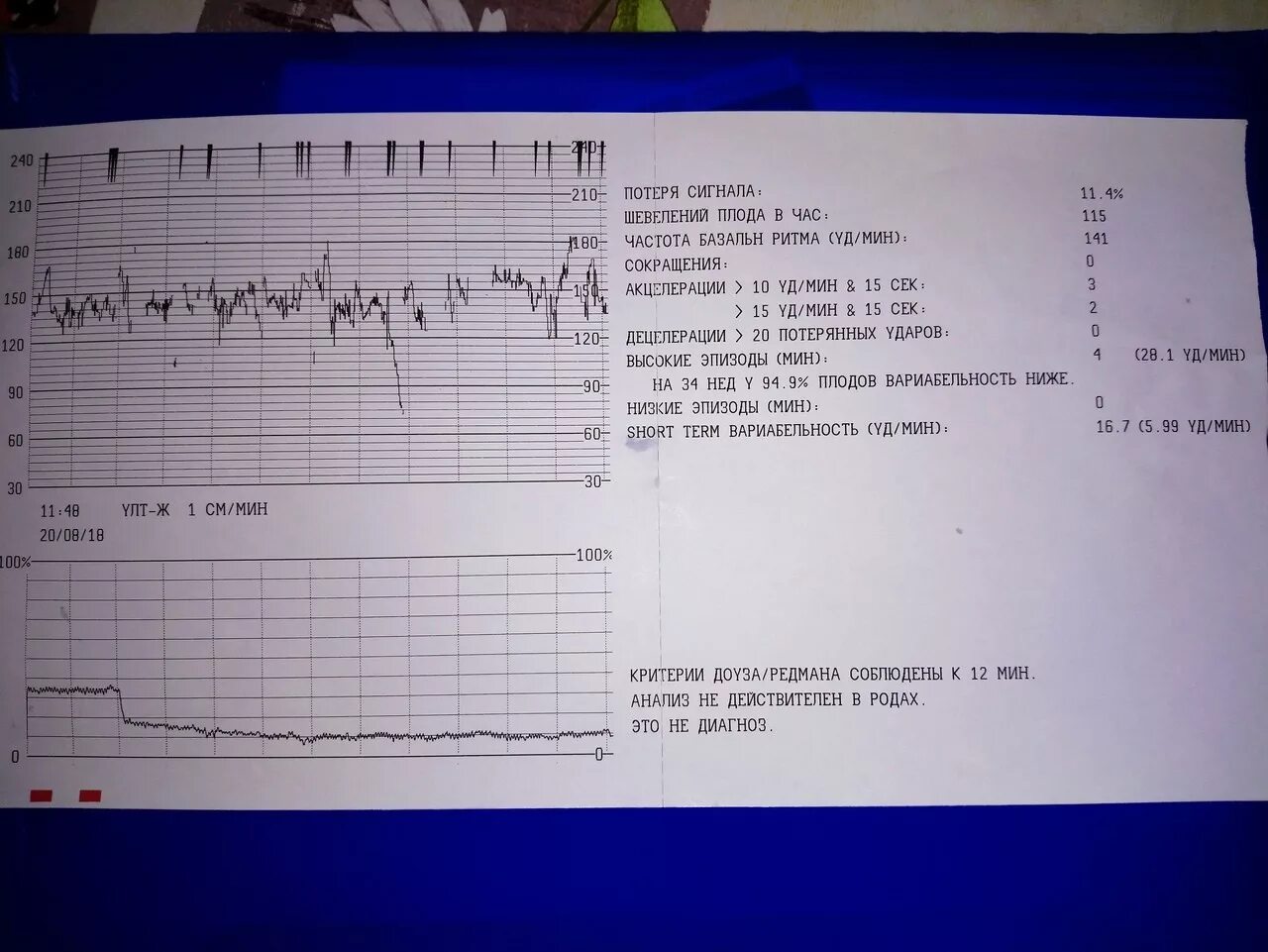 Схватки на 34. КТГ У беременных на 34 неделе беременности. Расшифровка КТГ плода 34 недели беременности. КТГ при беременности расшифровка расшифровка. КТГ 3 недель нормальные показатели.