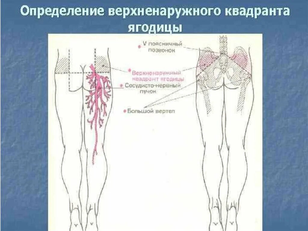 Схема уколов внутримышечно. Верхний наружный Квадрант ягодичной. Внешний наружный Квадрант ягодицы. Верхний наружней квадрат. Верхний Квадрант ягодицы.