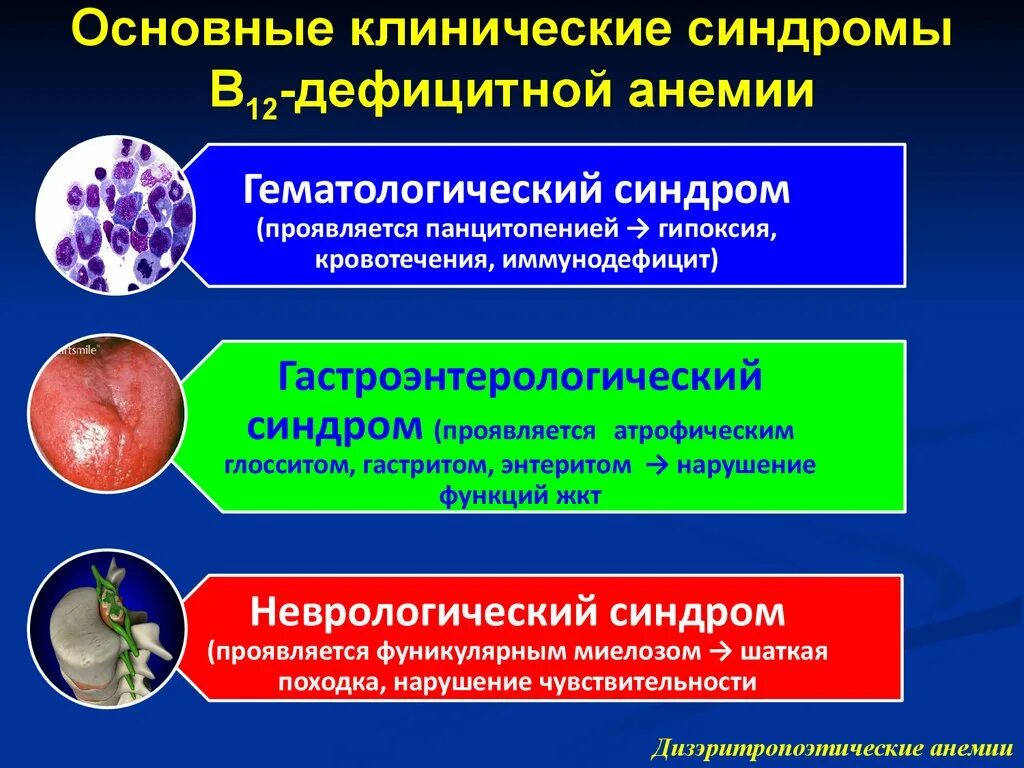 Б 12 исследования. Синдромы при б12 дефицитной анемии. Фолиеводефицитная анемия синдромы. Клинические синдромы в12 дефицитной анемии. В 12 железодефицитная анемия.