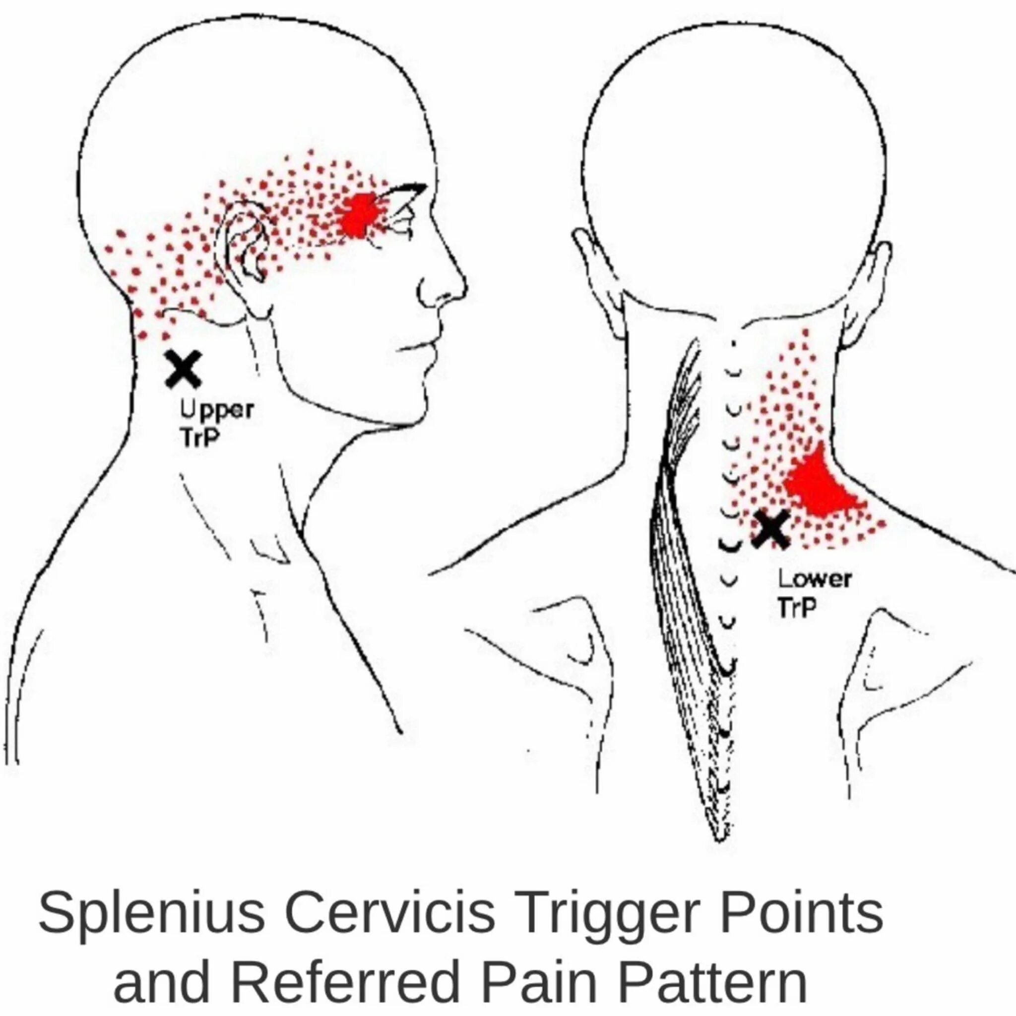 Болезненные точки на голове. Мышцы шеи триггерные точки схема. Боль в шее триггерные точки. Триггерные точки на шее сбоку. Болит шея триггерные точки.