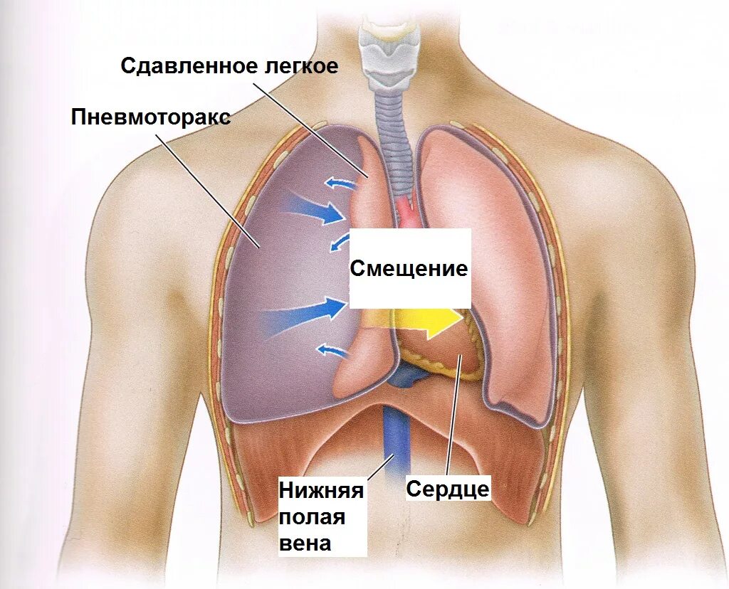 Пневмоторакс легких что это