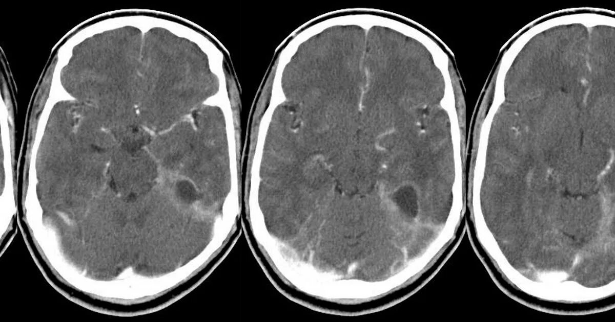 Субдуральная эмпиема кт. Субдуральная эмпиема на мрт. Экстрадуральный абсцесс кт. Субдуральный абсцесс кт. Гематома мозга операция