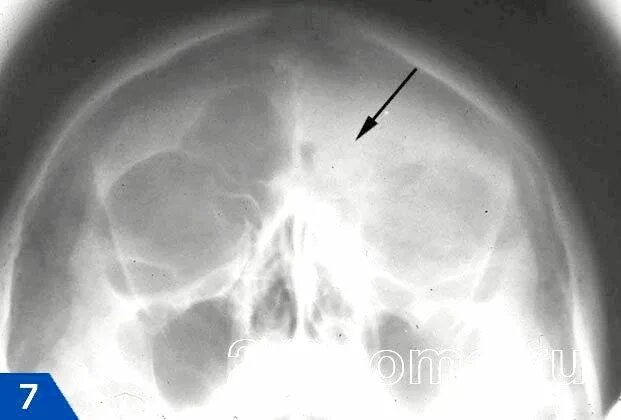 гипоплазия лобных пазух рентген. остеома верхнечелюстной пазухи рентген. гипоплазия лобных пазух рентген. остеома левой лобной пазухи. гипоплазия лобных пазух рентген.