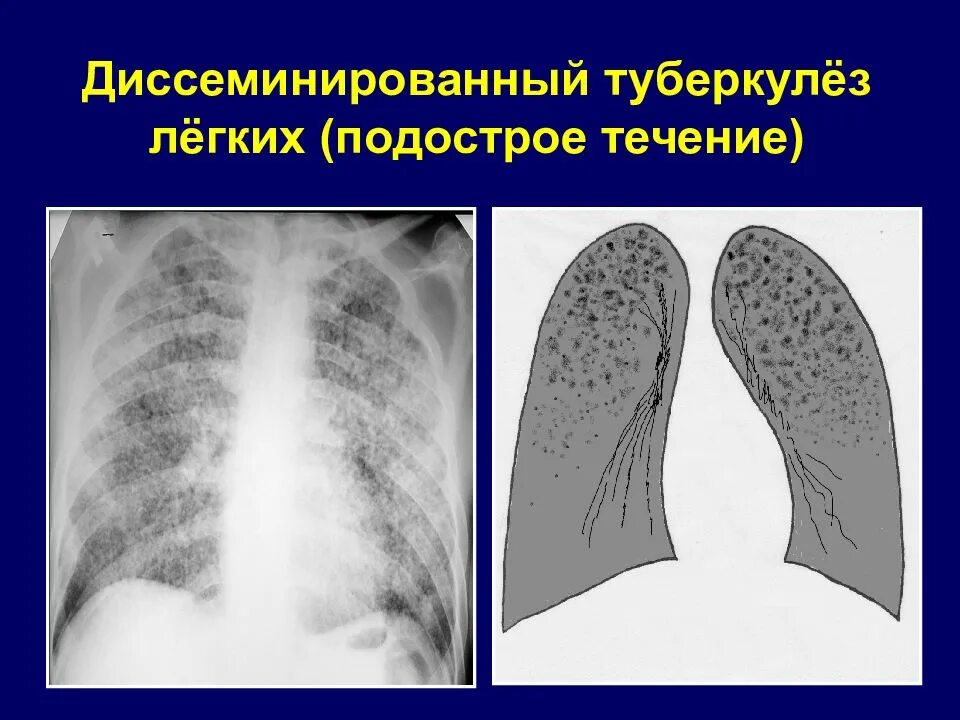 Диссеминированный туберкулез фаза инфильтрации