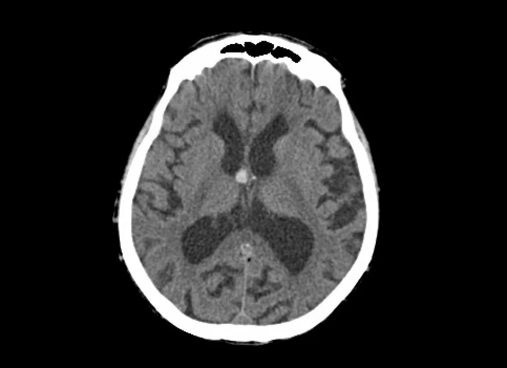 Киста желудочка головного мозга. Коллоидная киста 3 желудочка головного мозга. Киста головного мозга на кт. Порэнцефалическая киста. Коллоидная киста третьего желудочка на кт.