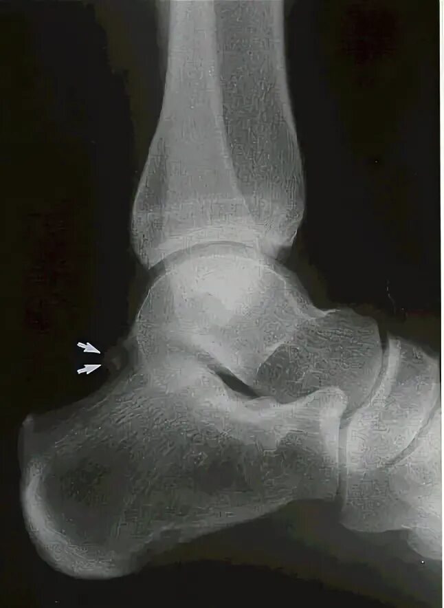 артроз таранно-ладьевидного сустава рентген. артроз ладьевидной кости. таранно-ладьевидный артроз 1 степени. артроз таранно-ладьевидного сустава рентген. артроз голеностопа 1 степени.